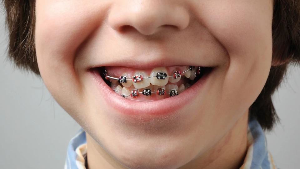 Ngempeng Sebabkan Gigi Tonggos Pada Anak Yuk Cegah Dengan Cara Ini