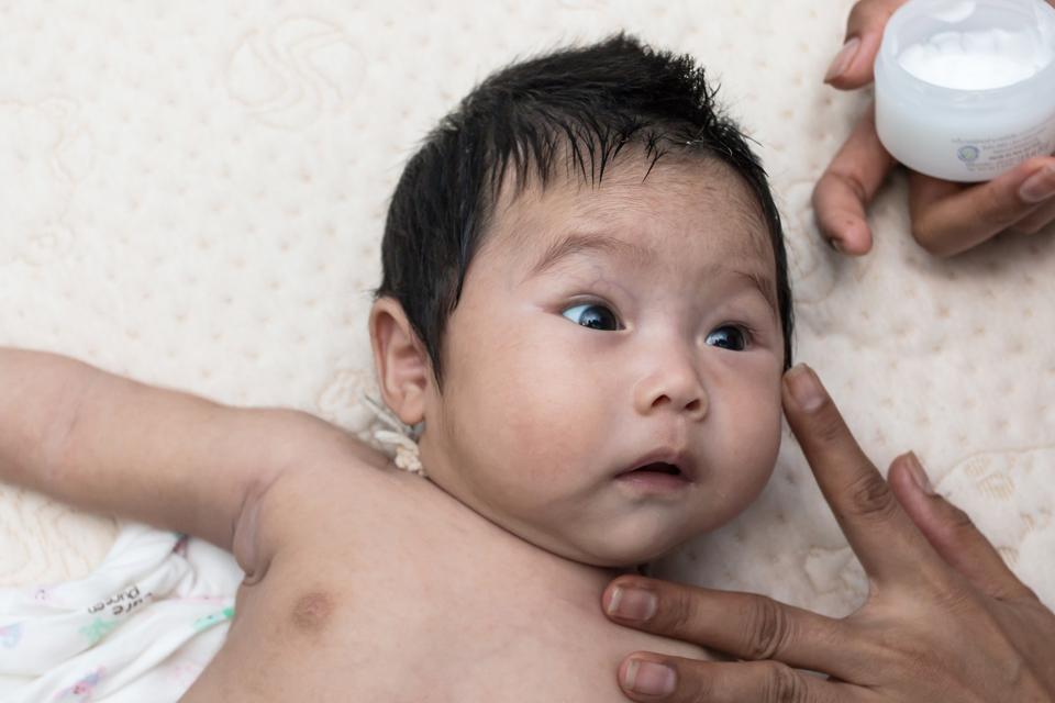Kulit Bayi Merah dan Gatal? Bisa Jadi Dermatitis Atopik pada Bayi